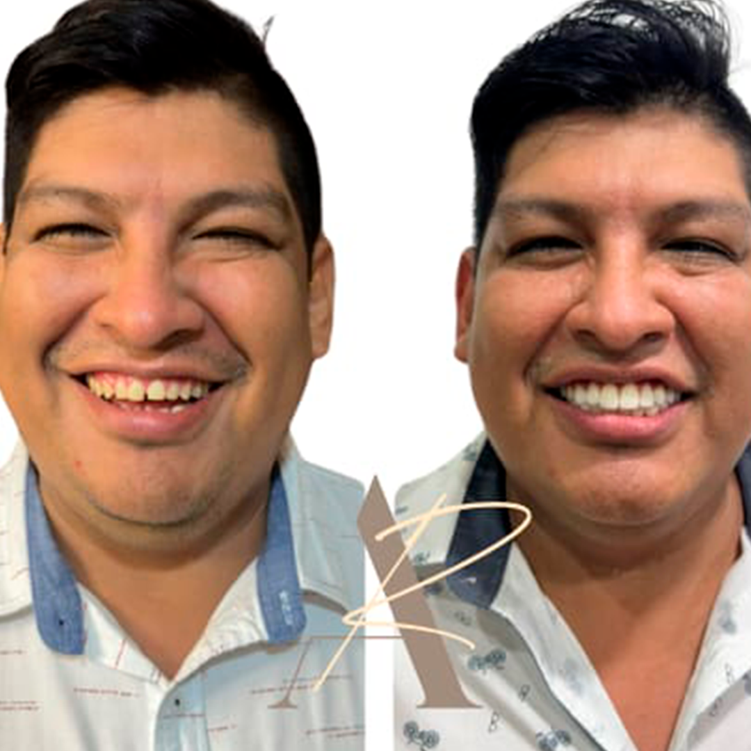 Antes e depois - Caso 2
