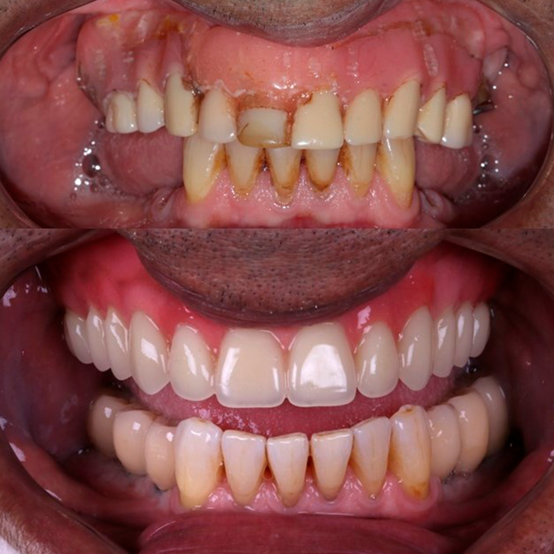 Antes e depois - Caso 4